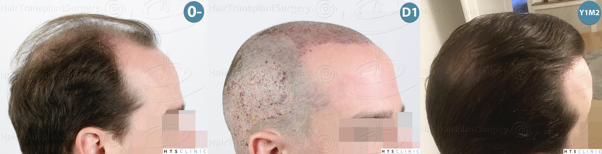 Dr.Devroye-HTS-Clinic-3878-FUE-NW-V-Montage-4