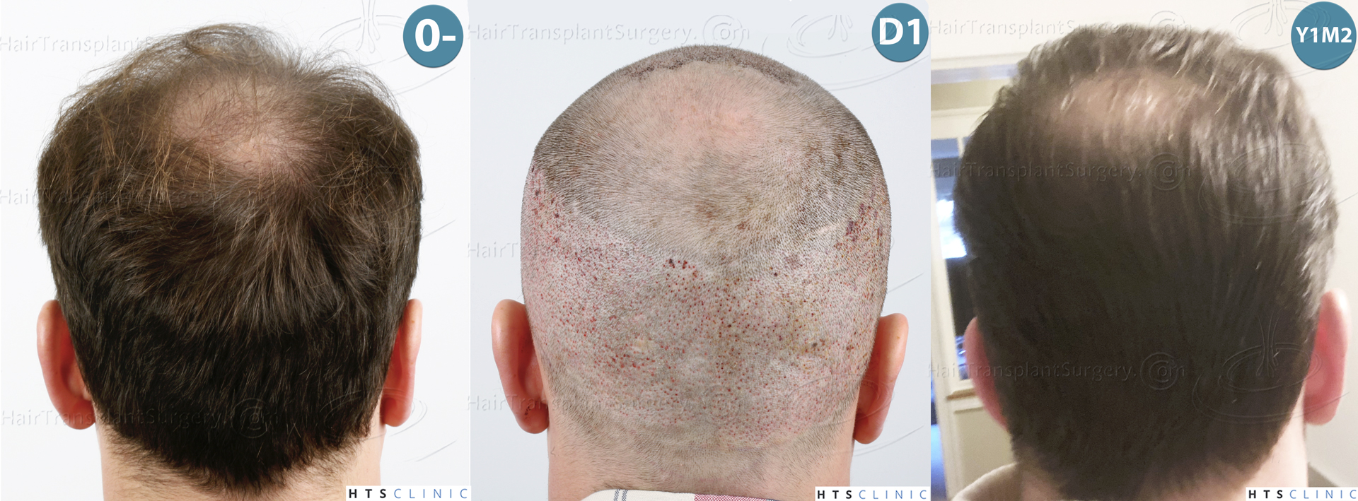 Dr.Devroye-HTS-Clinic-3878-FUE-NW-V-Montage-5