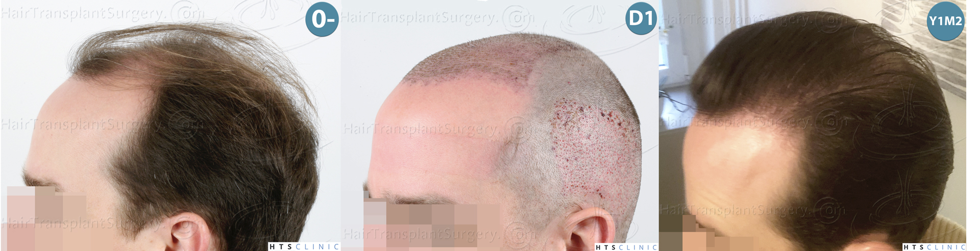 Dr.Devroye-HTS-Clinic-3878-FUE-NW-V-Montage-3