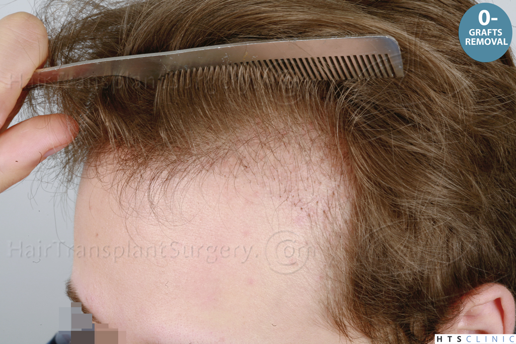 Dr.Devroye-HTS-Clinic-1489-FUE-Repair_Gr