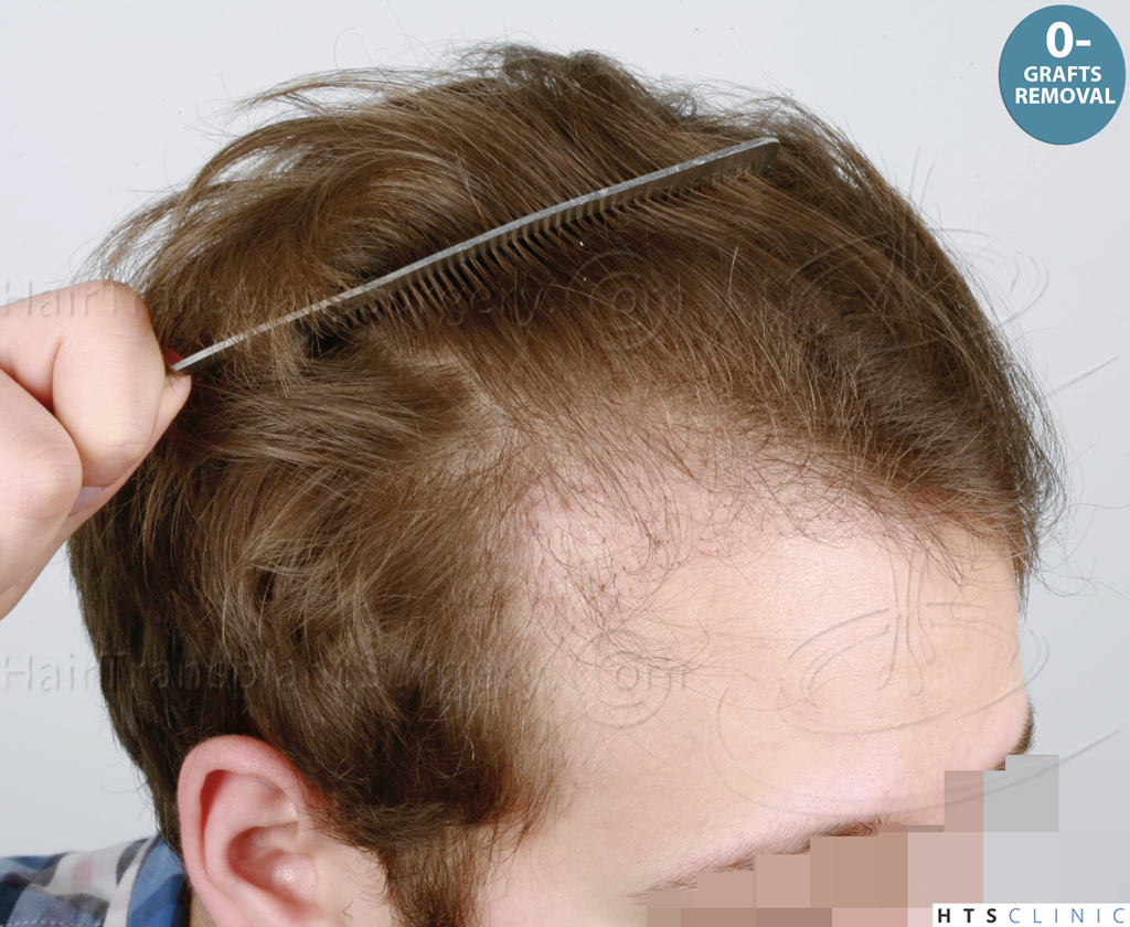 Dr.Devroye-HTS-Clinic-1489-FUE-Repair_Grafts_Removal-5