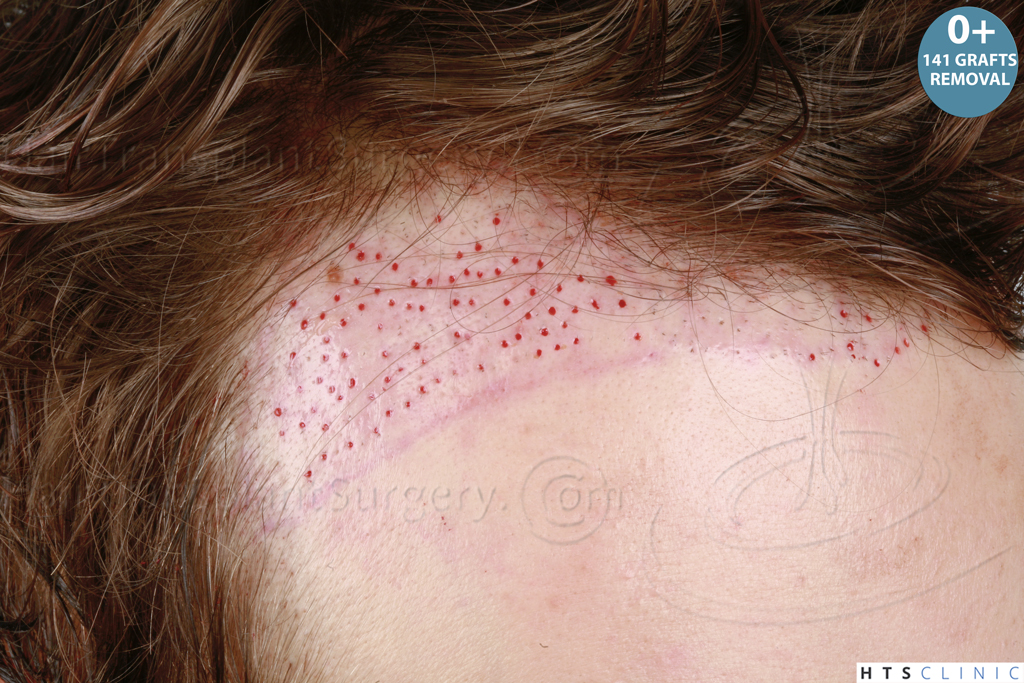 Dr.Devroye-HTS-Clinic-1489-FUE-Repair_Grafts_Removal-7