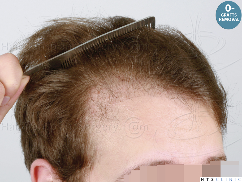 Dr.Devroye-HTS-Clinic-1489-FUE-Repair_Grafts_Removal-4