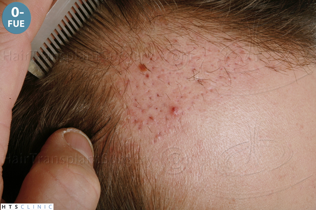 Dr.Devroye-HTS-Clinic-1489-FUE-Repair_Grafts_Removal-12