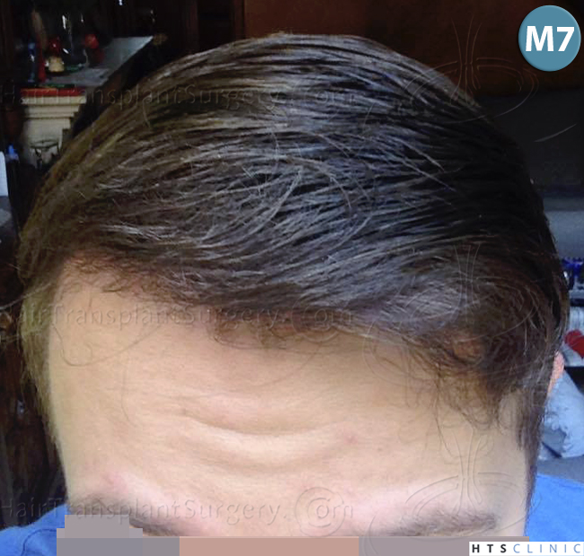 Dr.Devroye-HTS-Clinic-1489-FUE-Repair_Grafts_Removal-22