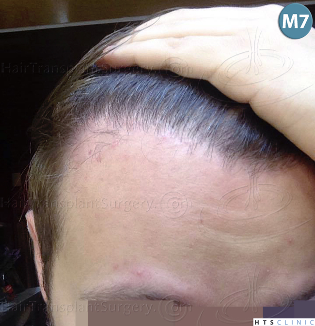 Dr.Devroye-HTS-Clinic-1489-FUE-Repair_Grafts_Removal-24