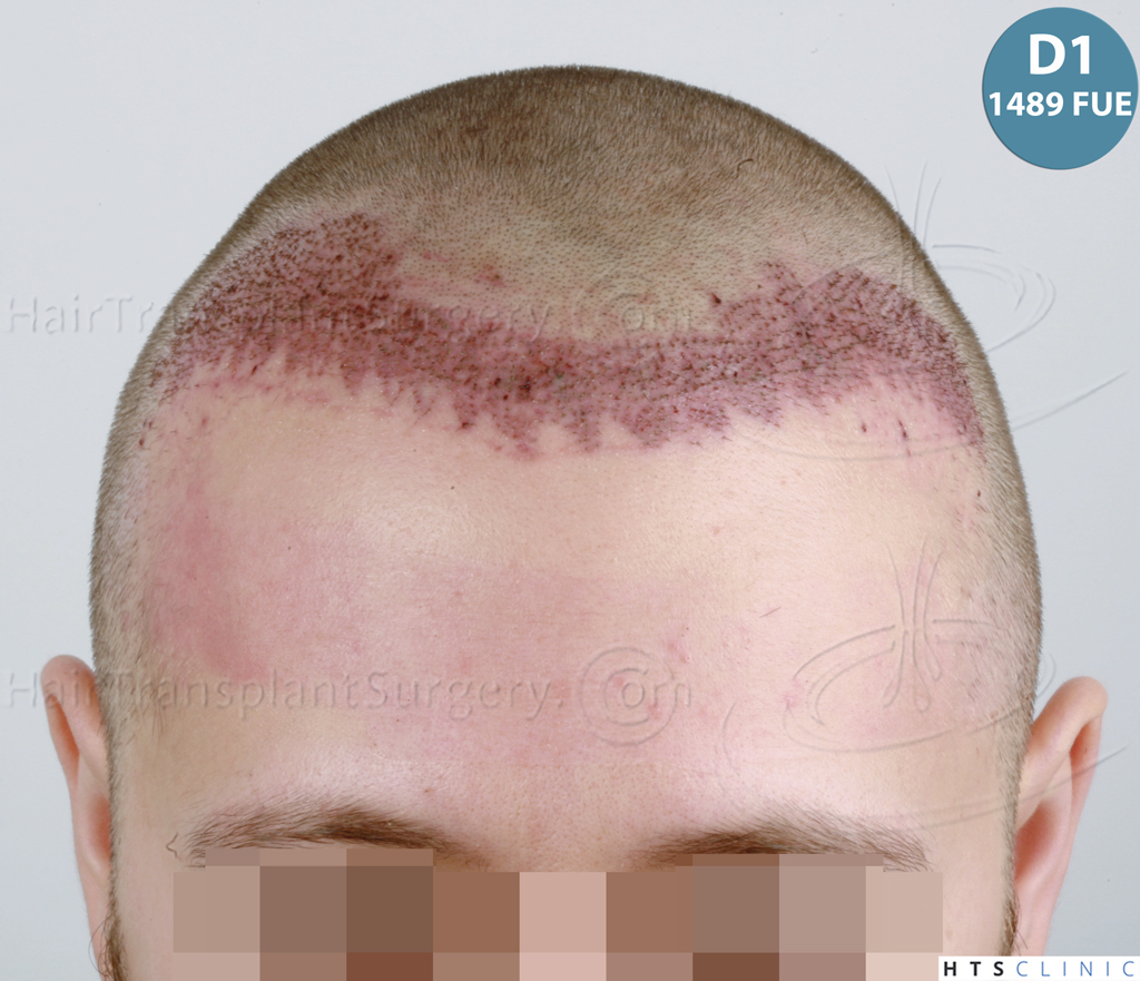 Dr.Devroye-HTS-Clinic-1489-FUE-Repair_Grafts_Removal-18