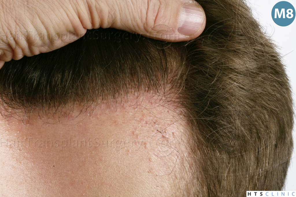 Dr.Devroye-HTS-Clinic-1489-FUE-Repair_Grafts_Removal-29