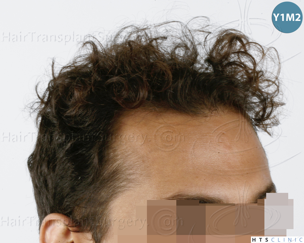 Dr.Devroye-HTS-Clinic-3757-FUT_2138-FUE-