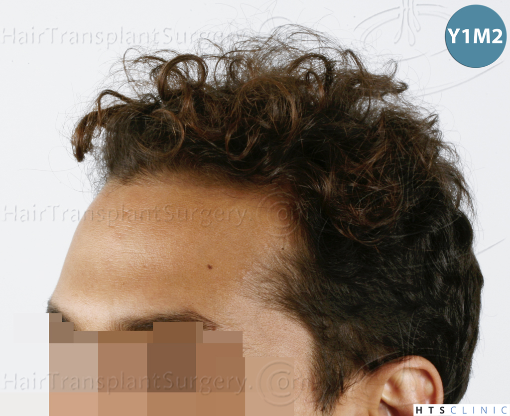 Dr.Devroye-HTS-Clinic-3757-FUT_2138-FUE-2.jpg