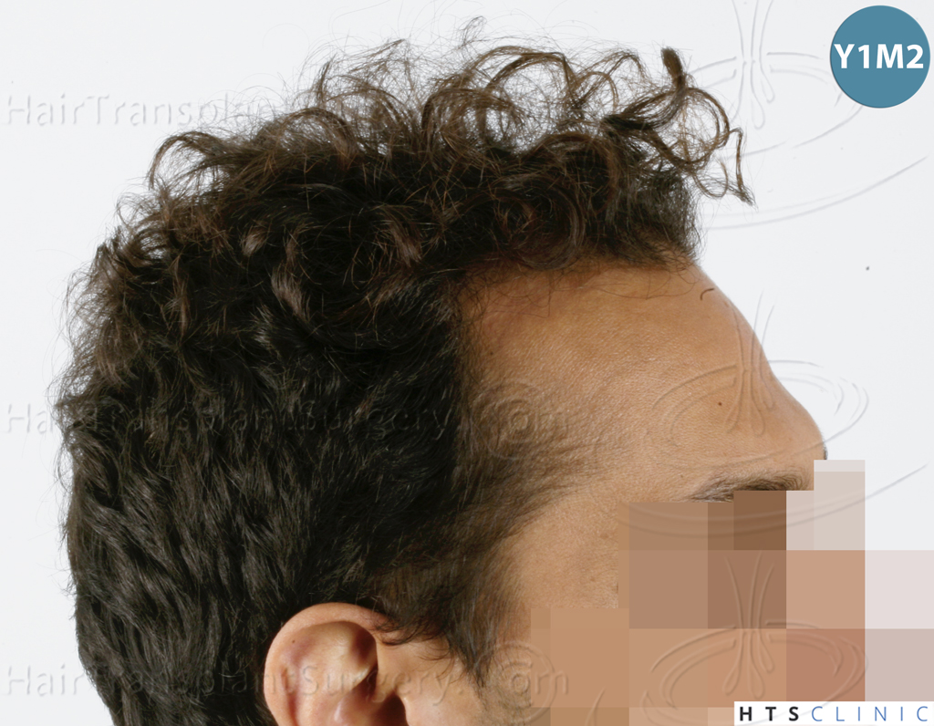 Dr.Devroye-HTS-Clinic-3757-FUT_2138-FUE-