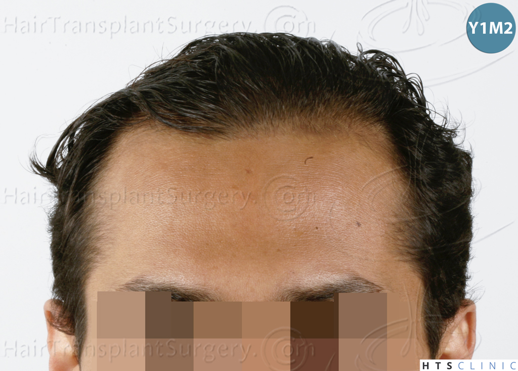 Dr.Devroye-HTS-Clinic-3757-FUT_2138-FUE-7.jpg