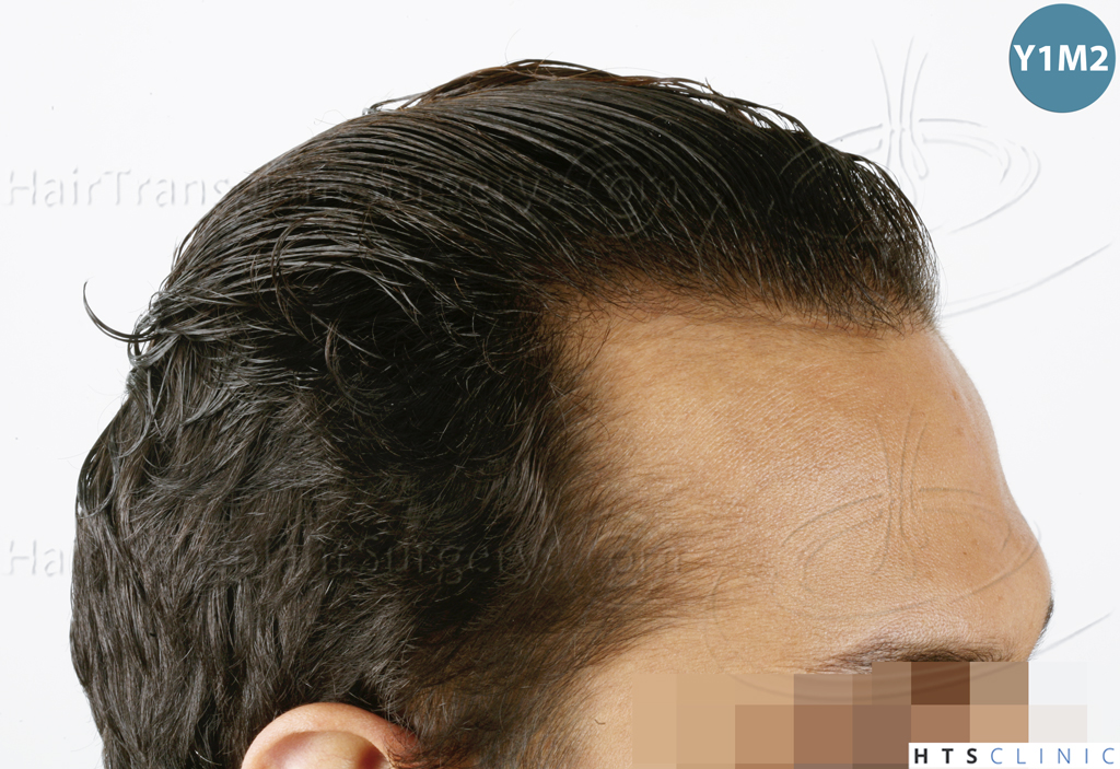 Dr.Devroye-HTS-Clinic-3757-FUT_2138-FUE-10.jpg