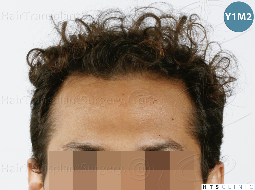 Dr.Devroye-HTS-Clinic-3757-FUT_2138-FUE-