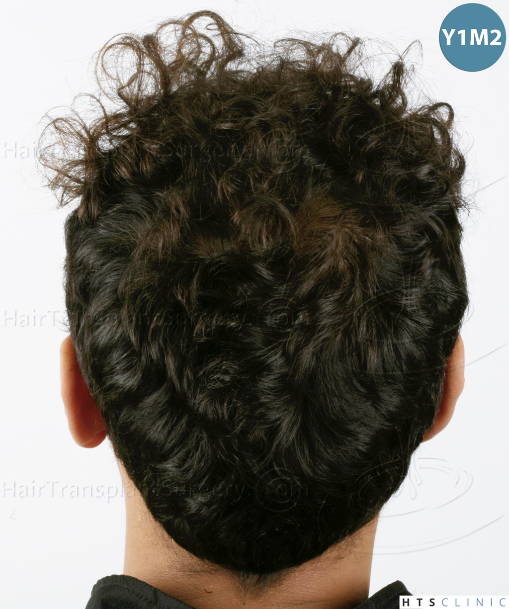 Dr.Devroye-HTS-Clinic-3757-FUT_2138-FUE-6.jpg