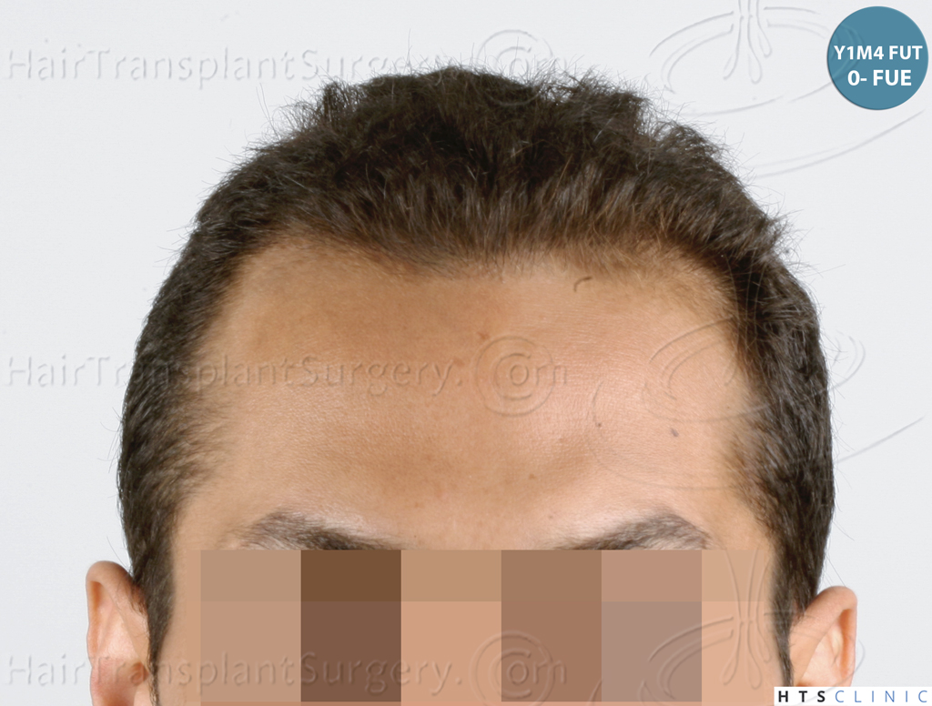 Dr.Devroye-HTS-Clinic-3757-FUT_2138-FUE-11.jpg