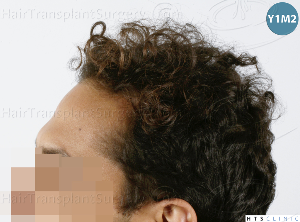 Dr.Devroye-HTS-Clinic-3757-FUT_2138-FUE-