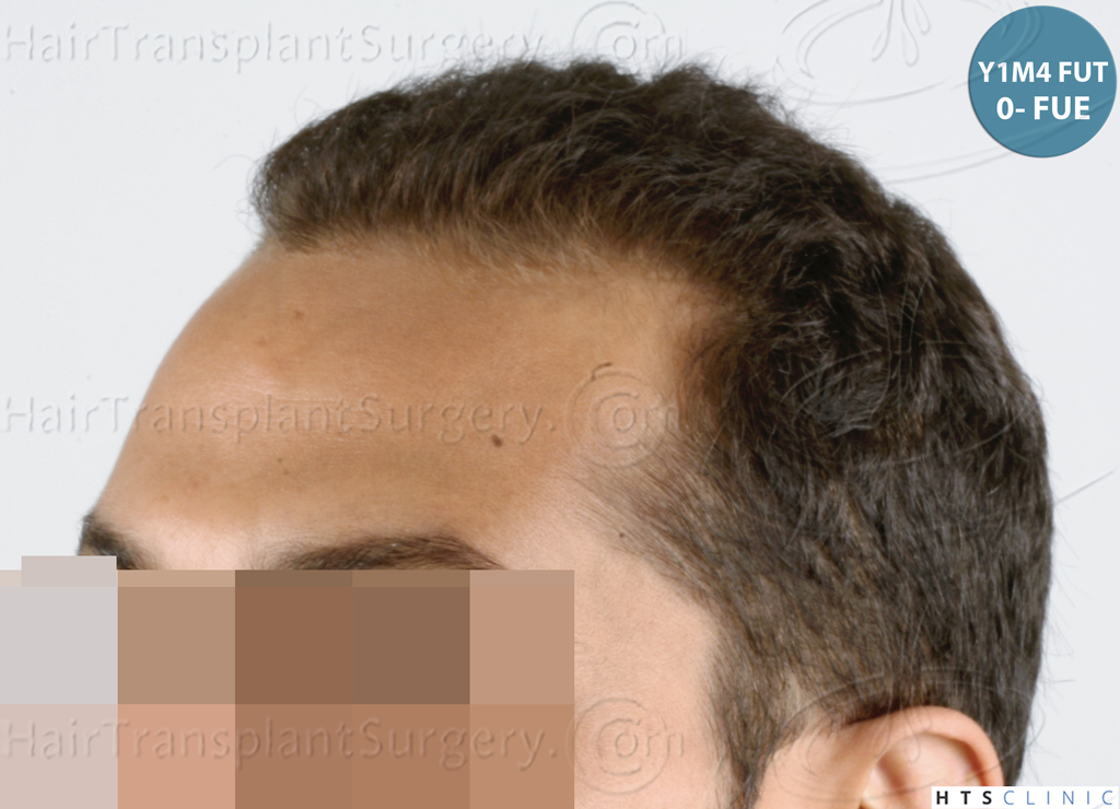 Dr.Devroye-HTS-Clinic-3757-FUT_2138-FUE-14.jpg