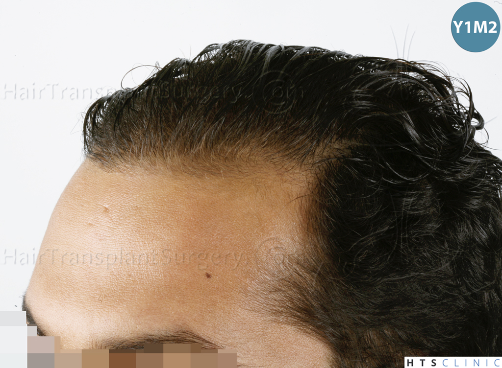 Dr.Devroye-HTS-Clinic-3757-FUT_2138-FUE-9.jpg