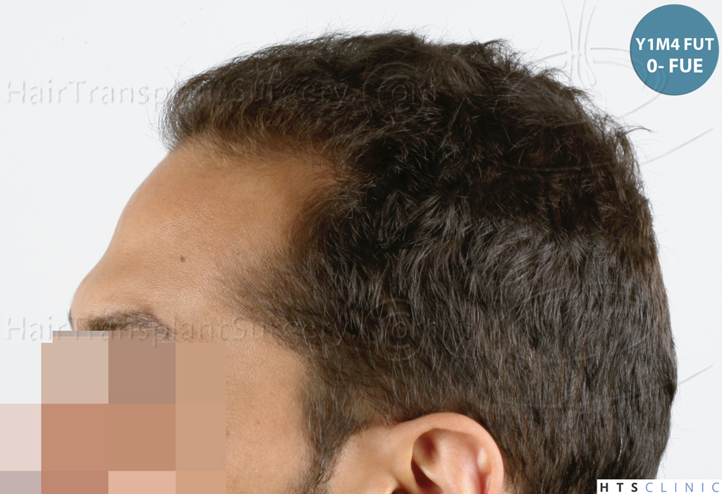 Dr.Devroye-HTS-Clinic-3757-FUT_2138-FUE-15.jpg