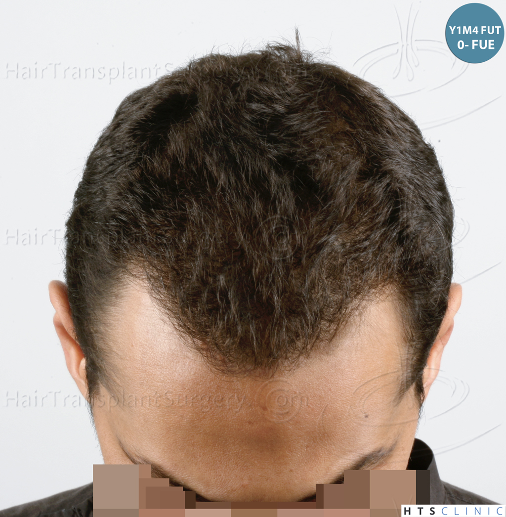 Dr.Devroye-HTS-Clinic-3757-FUT_2138-FUE-12.jpg