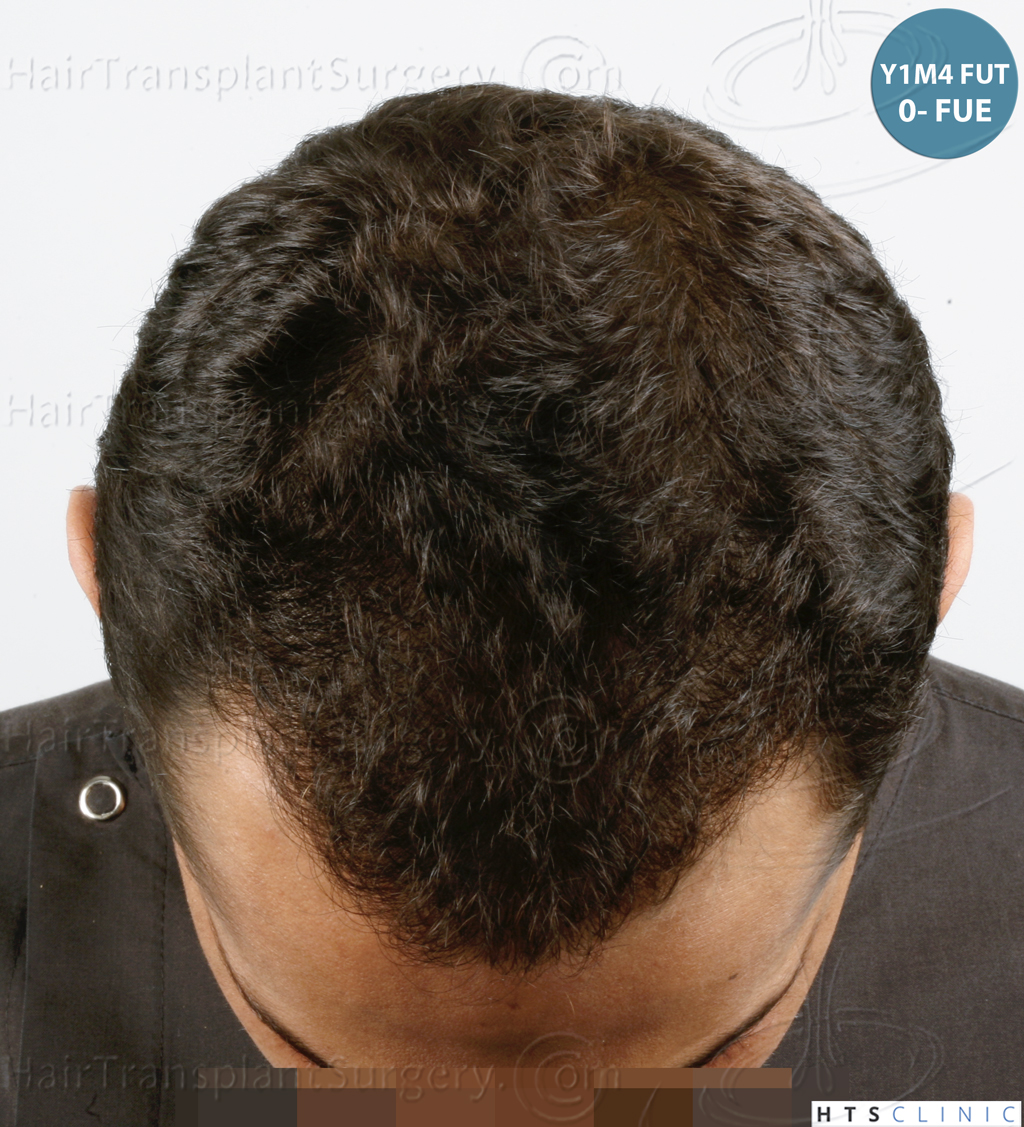 Dr.Devroye-HTS-Clinic-3757-FUT_2138-FUE-