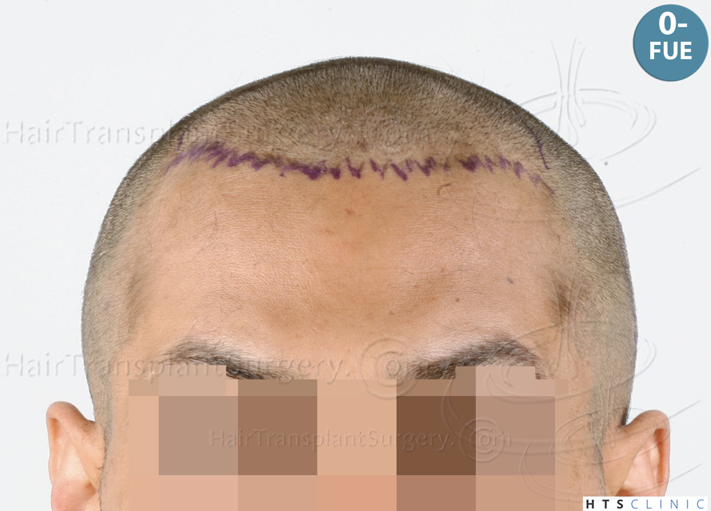 Dr.Devroye-HTS-Clinic-3757-FUT_2138-FUE-