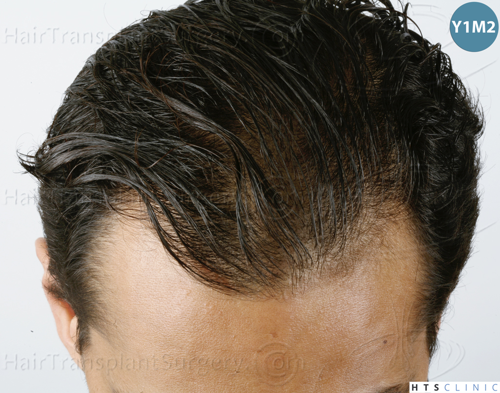 Dr.Devroye-HTS-Clinic-3757-FUT_2138-FUE-8.jpg