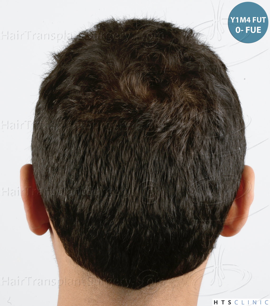 Dr.Devroye-HTS-Clinic-3757-FUT_2138-FUE-18.jpg