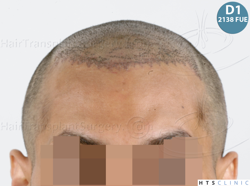Dr.Devroye-HTS-Clinic-3757-FUT_2138-FUE-23.jpg