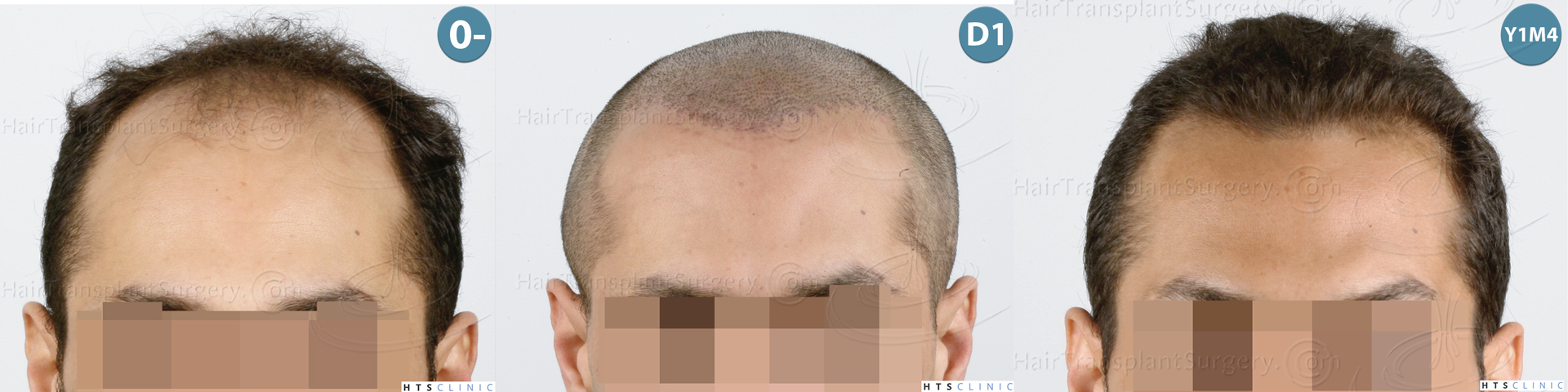 Dr.Devroye-HTS-Clinic-3757-FUT_2138-FUE-