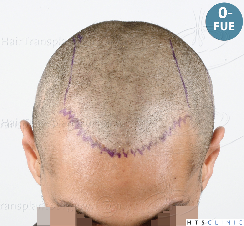 Dr.Devroye-HTS-Clinic-3757-FUT_2138-FUE-21.jpg