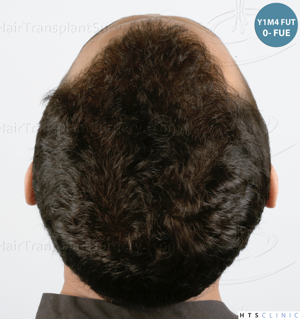 Dr.Devroye-HTS-Clinic-3757-FUT_2138-FUE-19.jpg