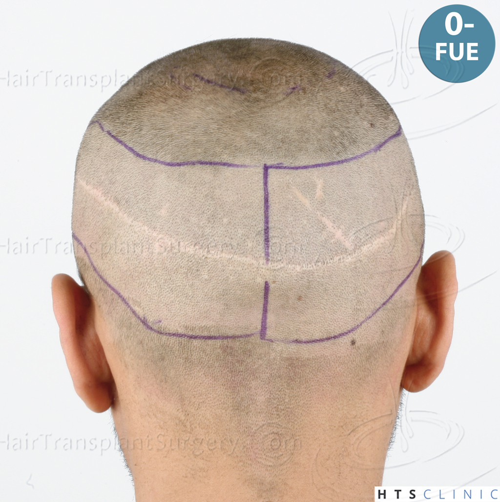 Dr.Devroye-HTS-Clinic-3757-FUT_2138-FUE-22.jpg