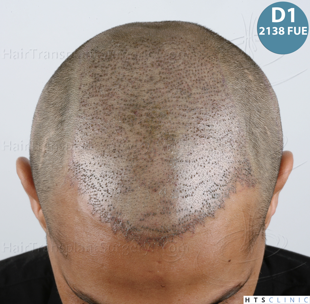 Dr.Devroye-HTS-Clinic-3757-FUT_2138-FUE-