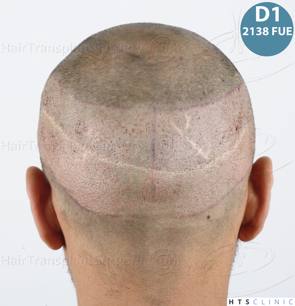 Dr.Devroye-HTS-Clinic-3757-FUT_2138-FUE-25.jpg