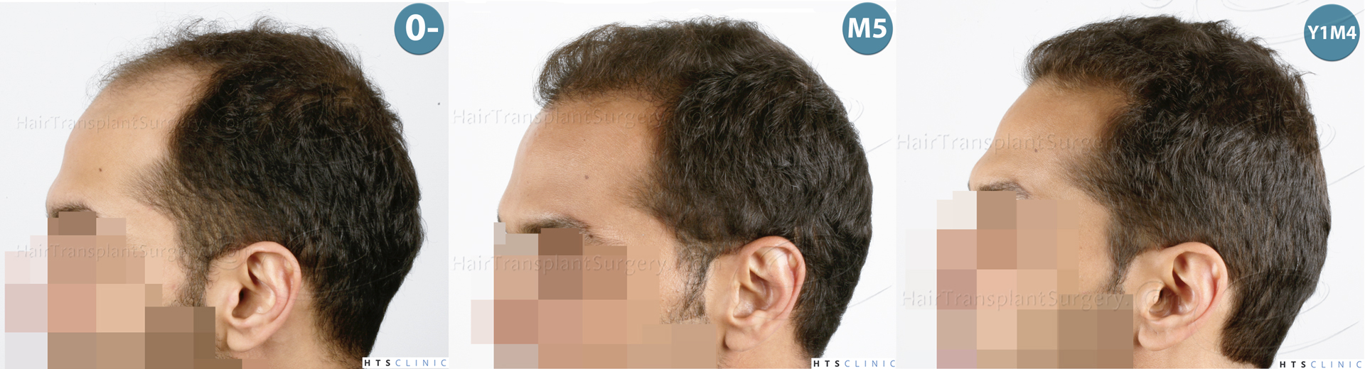 Dr.Devroye-HTS-Clinic-3757-FUT_2138-FUE-Montage3.jpg