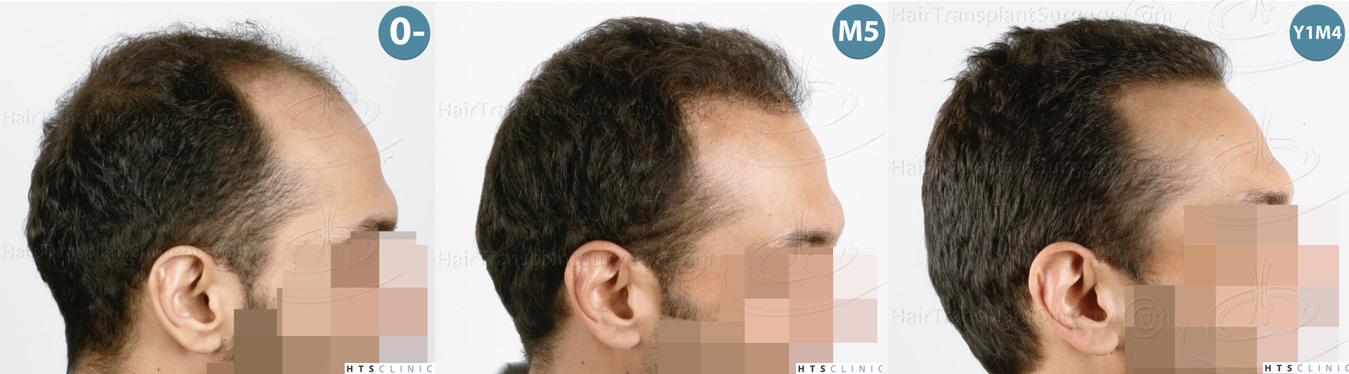 Dr.Devroye-HTS-Clinic-3757-FUT_2138-FUE-Montage4.jpg