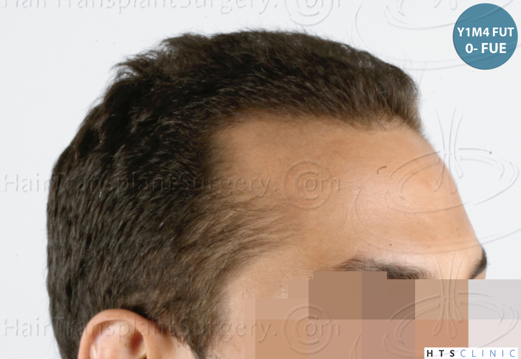 Dr.Devroye-HTS-Clinic-3757-FUT_2138-FUE-16.jpg