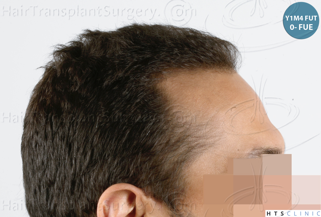 Dr.Devroye-HTS-Clinic-3757-FUT_2138-FUE-17.jpg