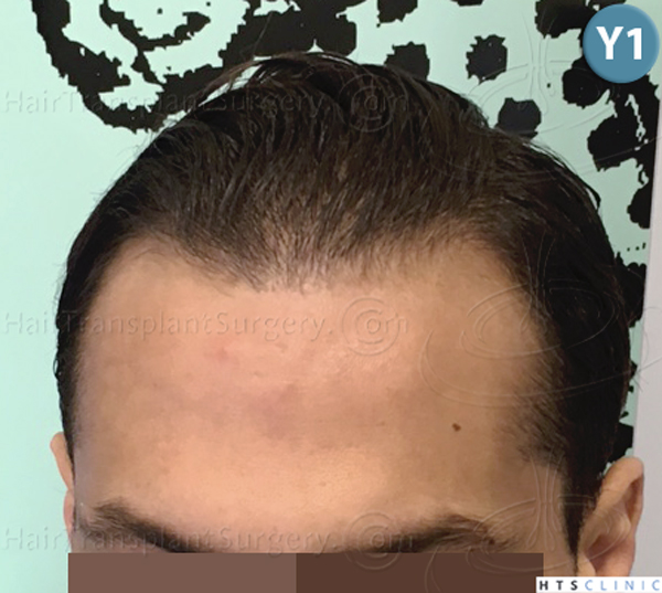 Dr.Devroye-HTS-Clinic-3757-FUT_2138-FUE-a.jpg