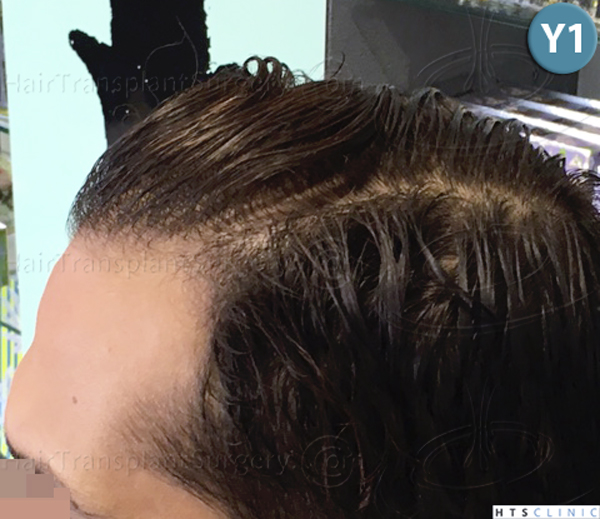 Dr.Devroye-HTS-Clinic-3757-FUT_2138-FUE-b.jpg