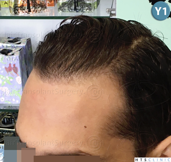 Dr.Devroye-HTS-Clinic-3757-FUT_2138-FUE-c.jpg