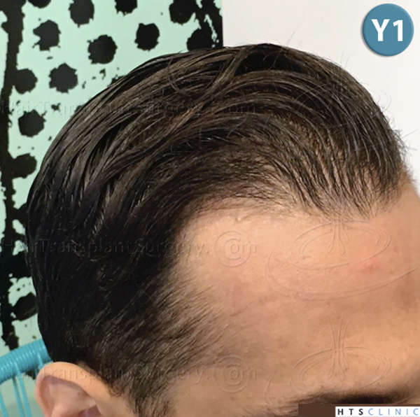 Dr.Devroye-HTS-Clinic-3757-FUT_2138-FUE-d.jpg