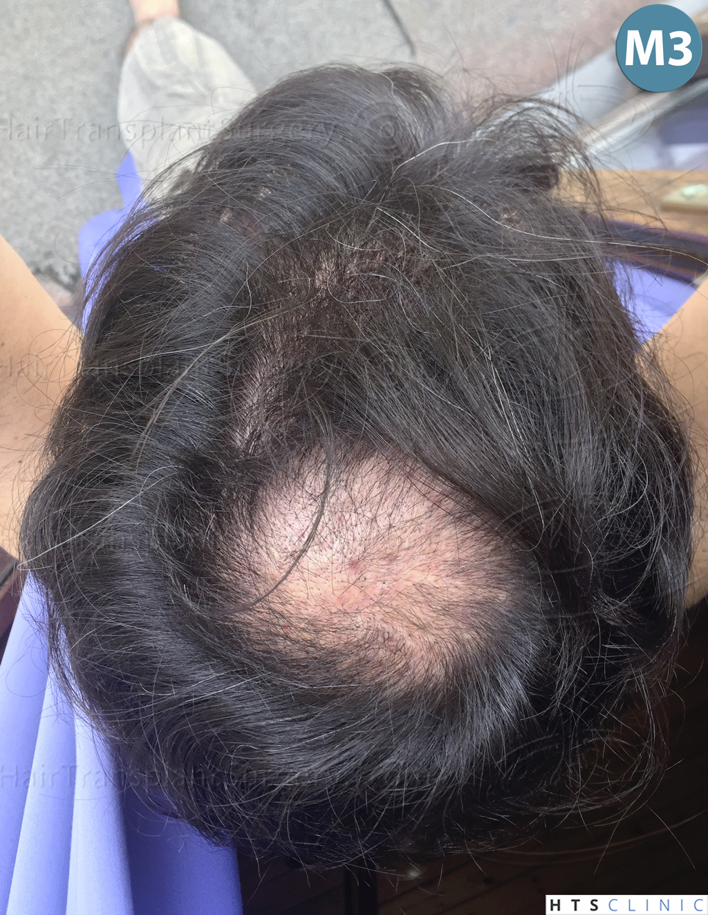 Dr.Devroye-HTS-Clinic-2515-FUT-Vertex-5.jpg