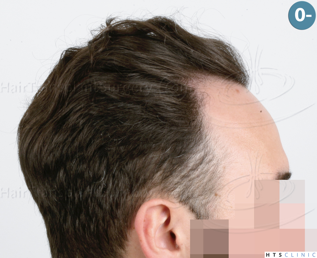 Dr.Devroye-HTS-Clinic-3545-FUE-5