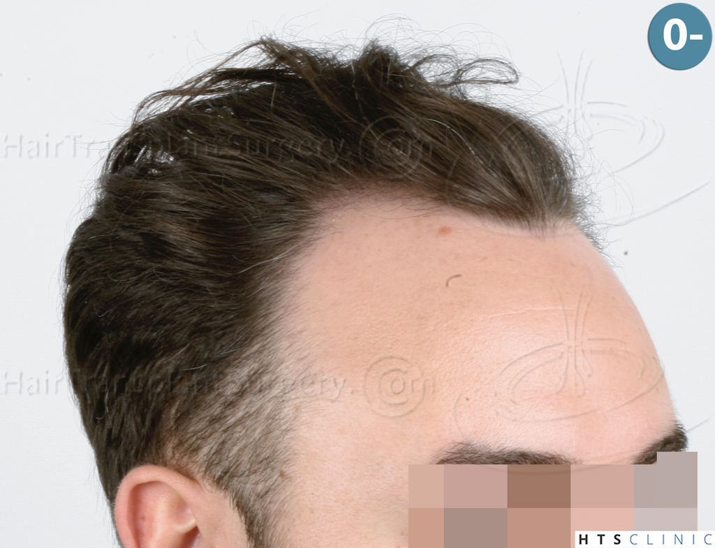 Dr.Devroye-HTS-Clinic-3545-FUE-6