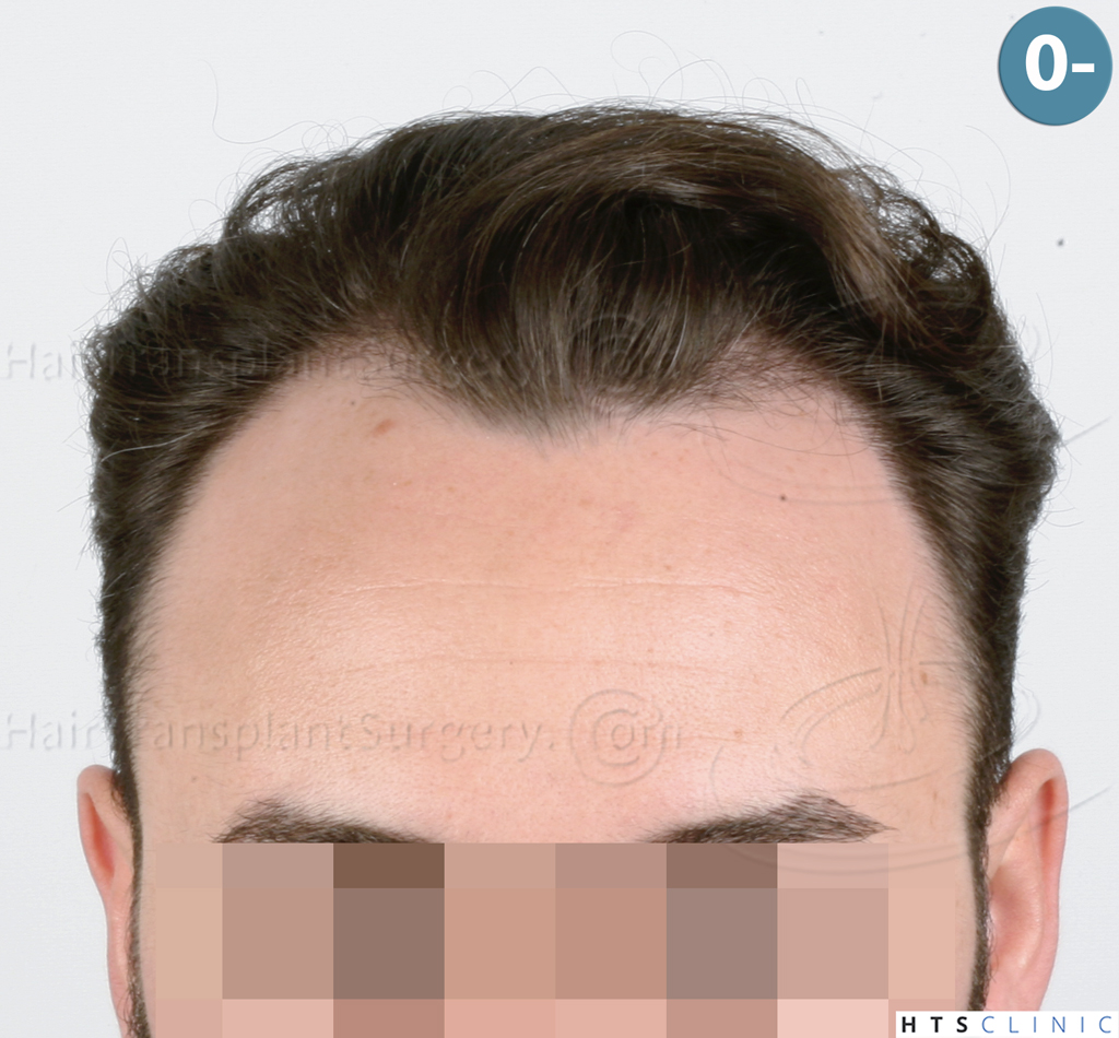 Dr.Devroye-HTS-Clinic-3545-FUE-1