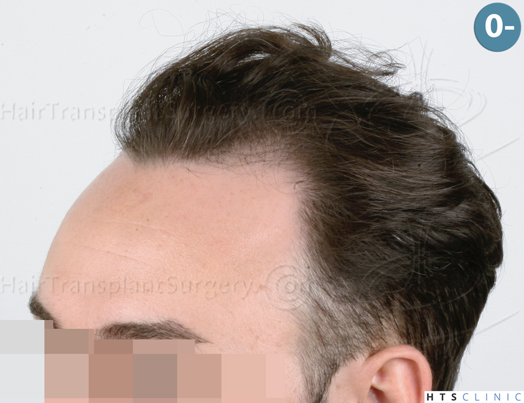 Dr.Devroye-HTS-Clinic-3545-FUE-4