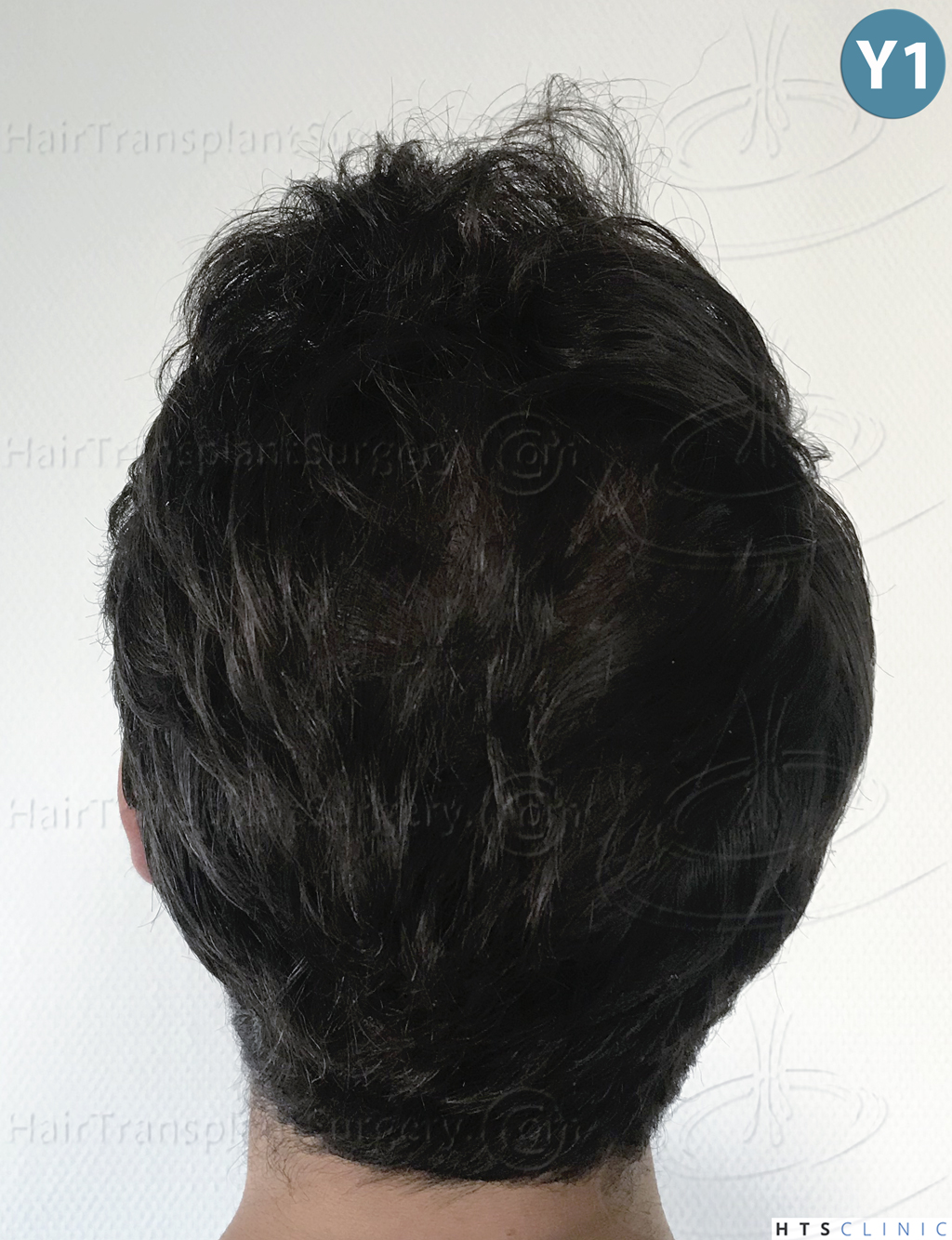 Dr.Devroye-HTS-Clinic-3545-FUE-35